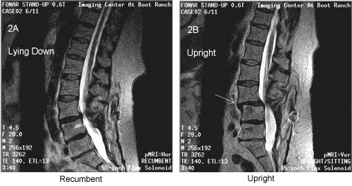 Postoperative Spinal Instability at L3-4 Revealed by Upright Weight-Bearing MRI