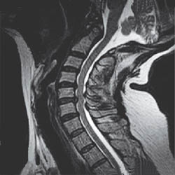 Unsuspected Disc Herniation on Extension