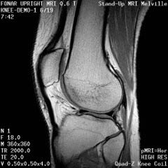 sagittal knee MRI
