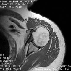 Shoulder MRI