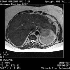 MRI of the T2 Axial Liver