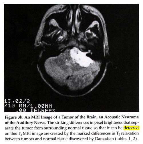 An MRI Image of a Tumor of the Brain, and Acoustic Neuroma