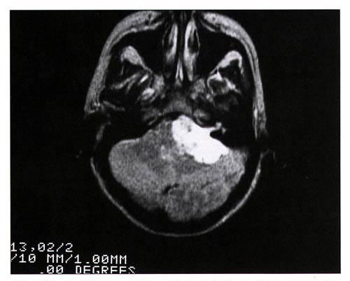 An MRI Image of a Tumor of the Brain, and Acoustic Neuroma
