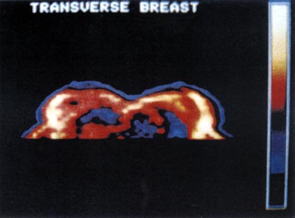 Figure 27. NMR image shows a region of low density in the left breast with elevated T1 values. The small black area in the right breast is compatible with the diagnosis of cyst. (mean: 127, width: 128)