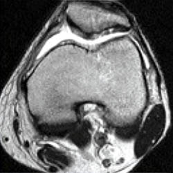 Knee MRI