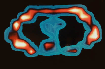 Figure 22. First-ever MRI scan of the live human body obtained 4:45 AM, July 3, 1977 on