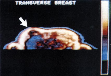 Figure 26. NMR image of the breast shows a large mass (dark area) in the central portion of the right breast. T1 data are consistent with the diagnosis of cyst. (mean: 151, width: 239) 