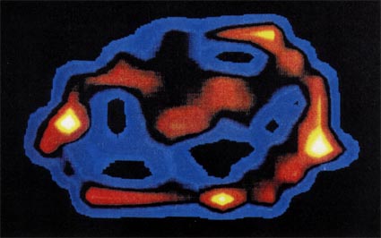 Figure 23c. FONAR cross-sectional scan through the low chest (10th thoracic vertebra) in a patient with advanced alveolar cell carcinoma. The tumor is seen as intense signal-producing tissue (red, and less signal-intense light blue) invading both lung cavities and obliterating the bulk of the air space. (1978) (Scanning time: 30 min.)