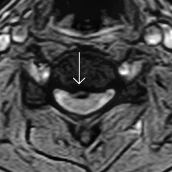 Lumbar Disc Herniation