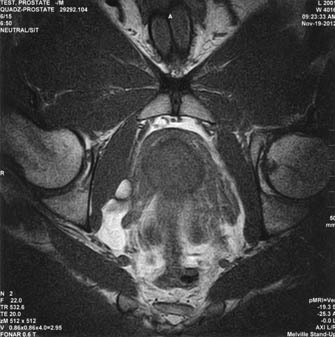 Fonar T1 Prostate MRI image