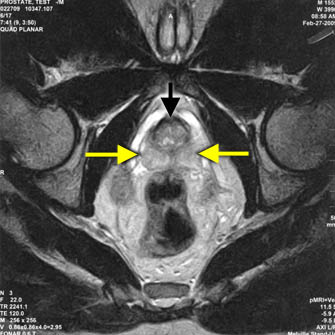 Fonar T2 Prostate MRI image