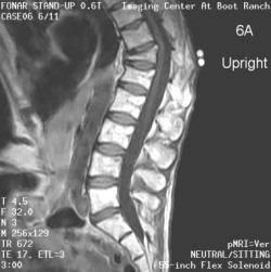 L-spine