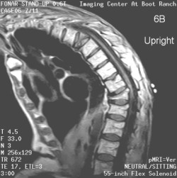 L-spine Kyphosis