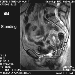 MRI of the bladder and uterine prolapse