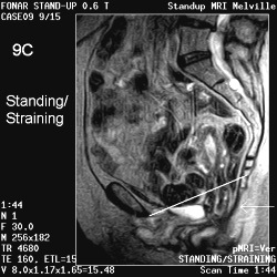 MRI of the bladder and uterine prolapse