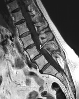 Standing Flexion (Dynamic)