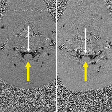 Fig. 5d-5c. Axial CSF Flow