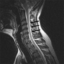 Figure 3a . Patient #6. Upright T2 Sagittal C5/6 obstructing CSF Flow Ventrally