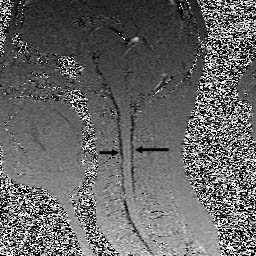 Figure 3c. MS Patient #6. Recumbent Sagittal CSF Flow. Ventral and dorsal CSF flow (black) intact in the recumbent position.