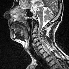 Figure 4a.  Patient #7. Recumbent T2 Sagittal Cerv.