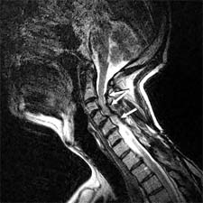 Figure 4b.  Patient #7. Upright T2 Sagittal Cerv.