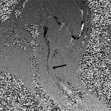 Figure 4c.  Patient #7. Upright Sagittal CSF Flow dorsally obstructed.