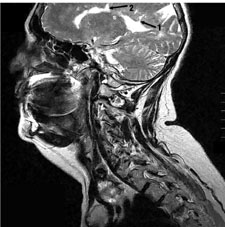 Figure 1a. - The original scan in which Damadian noted that the MS lesion in the first patient arose directly from the ventricles of the brain.