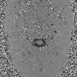  Figure 15b. Axial view of CSF flow in a normal patient