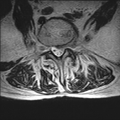 FONAR Spondylography - Sitting Extension