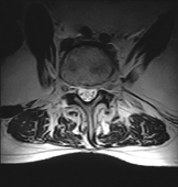 FONAR Spondylography - Sitting Flexion