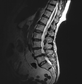 FONAR Spondylography - Sitting Extension