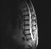 FONAR Spondylography - Sitting Flexion