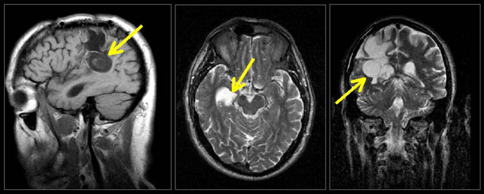Fig 8. Brain Tumor