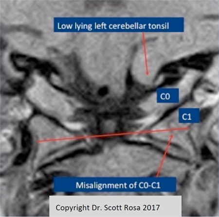Figure 9-Coronal view demonstrating misalignment of C0-C1 with left cerebellar tonsillar ectopia.