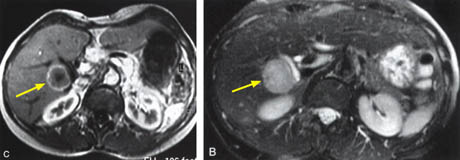 Fig.10. Liver Tumor
