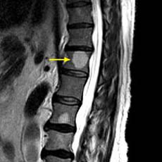 Fig. 10.Tumor Metastasis to Bone