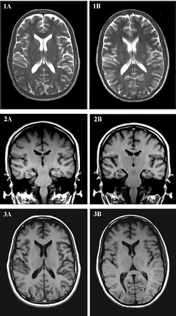 Brain MRI Comparison Images