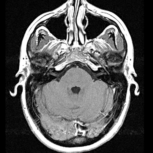 MRI Image