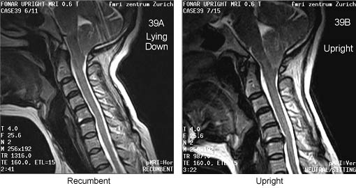 Chiari Malformation Visualization When Upright