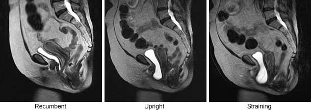 MRI Visualization of Position–Dependent Changes in the Pelvis: Pelvic Floor Dysfunction (PFD)