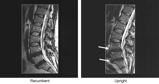 Visualization Of The Effects Of Gravity On The Intervertebral Discs In A True Physiological Upright Weight-Bearing MRI Scan