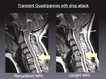 Transient Quadriparesis with Drop Attack and Chronic Neck and Arm Pain