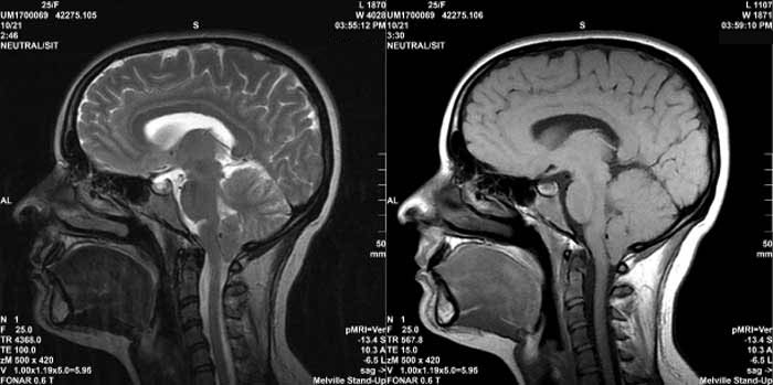 Side by Side-T2 sagittal MRI image of the brain -T1 sagittal MRI image of the brain