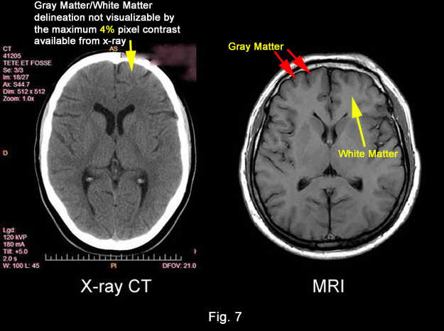 White Matter vs Gray Matter