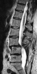 Upright, Weight-Bearing Lumbar MRI