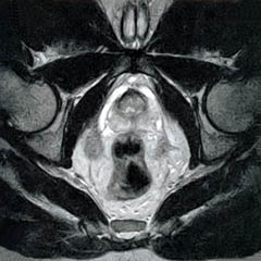 T2 MRI of the Prostate