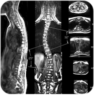 Scoliosis screening on the FONAR Upright MRI