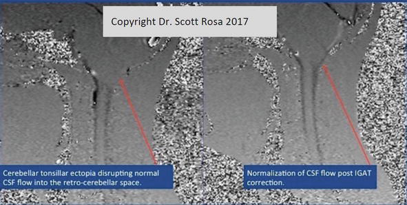 Figure 11-Disruption of CSF flow (left) with restoration of normal flow post IGAT (right) on phase contrast cine CSF flow MR.