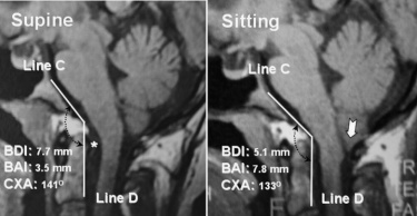 Results of vertical MR imaging in a 27-year-old woman with HDCT/CM-I.