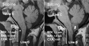 Belly Up or Down What are we missing? Prone vs. Supine MRI